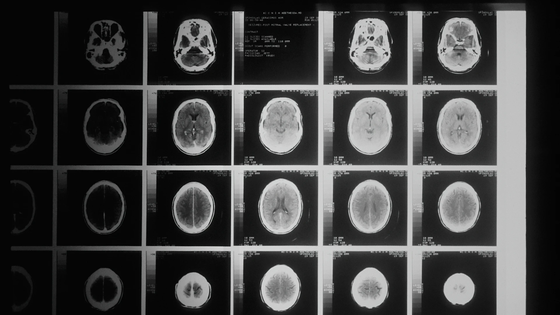 A series of MRI brain scan images
